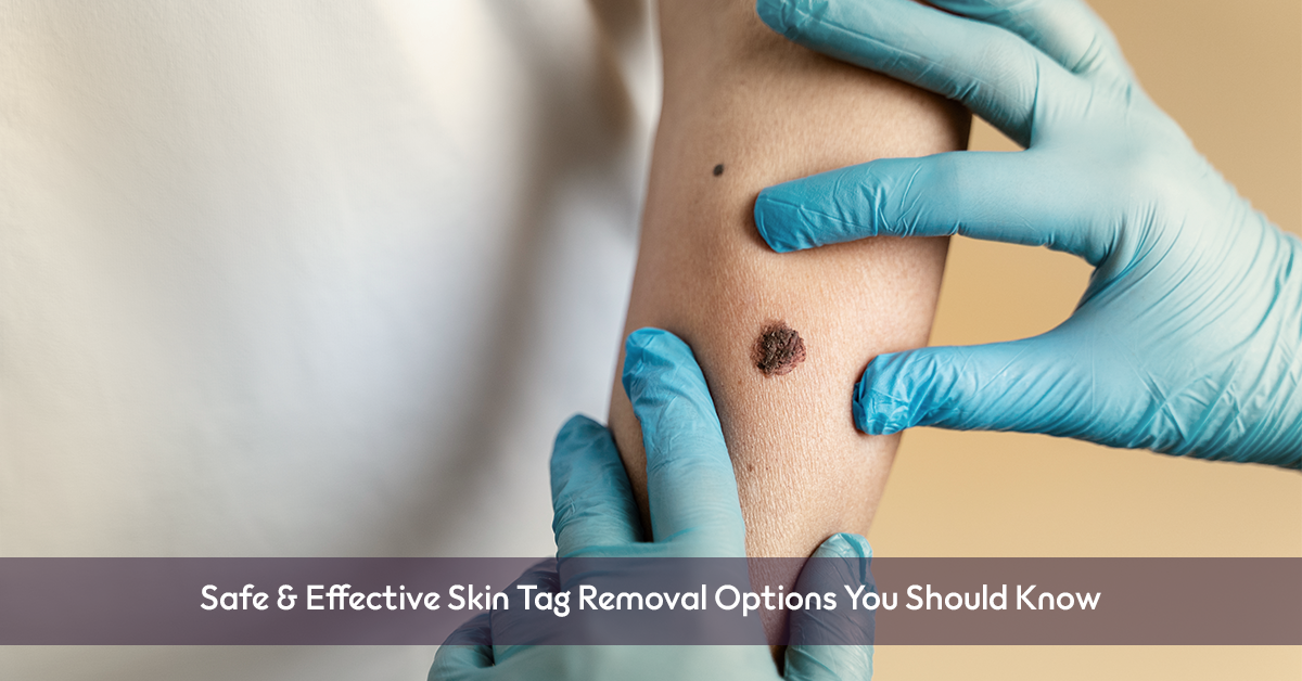 skin tag removal in Covina