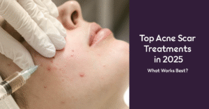Acne scar treatment in Covina
