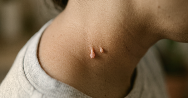 skin tag removal clinic